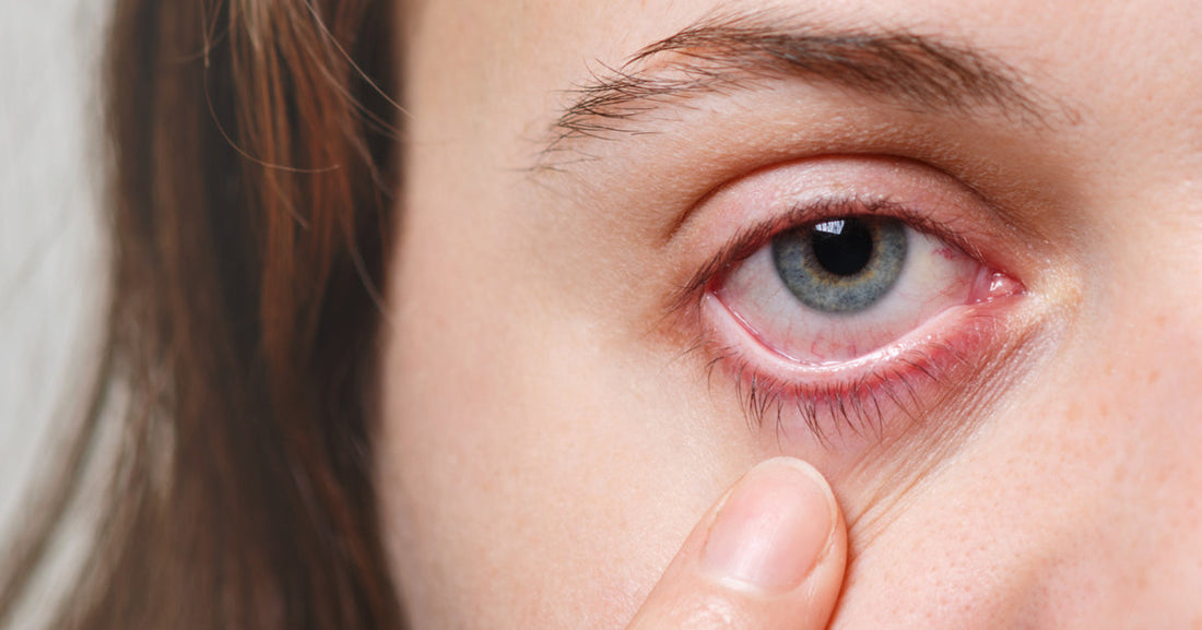 Dry Eyes