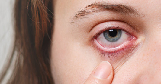 Dry Eyes